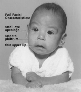 Photo of a baby with FAS pointing to facial characteristics